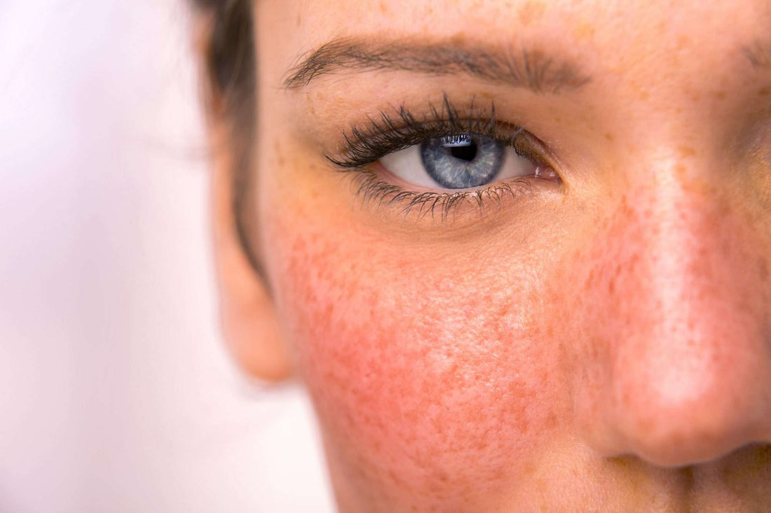 Understanding Rosacea: A Guide to Symptoms, Triggers, and Management